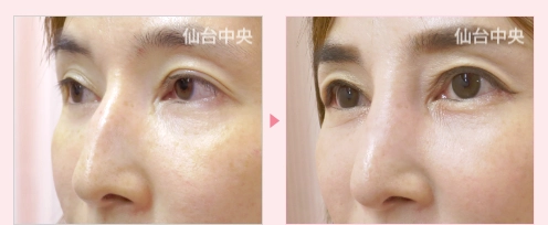 鷲鼻削り症例写真3