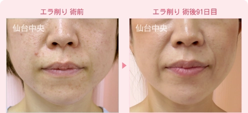 エラ削り 症例写真1