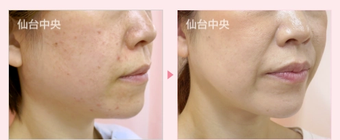 エラ削り 症例写真2