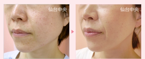 エラ削り 症例写真3