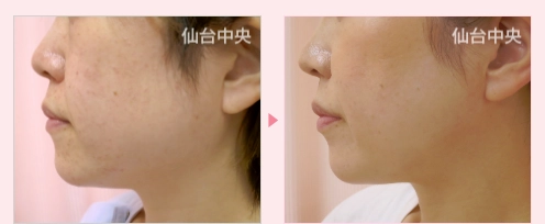 エラ削り 症例写真5