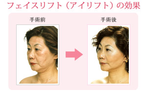 中央クリニック仙台院 フェイスリフト(アイリフト)の効果