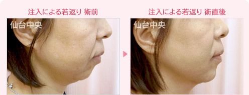 脂肪注入による若返り