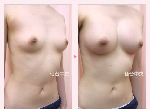 未婚女性の豊胸手術 症例写真2