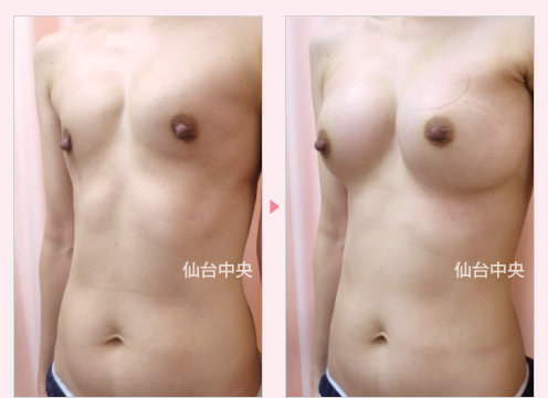 既婚の豊胸手術 症例写真3