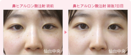 鼻ヒアルロン酸注入 症例写真1