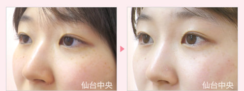 鼻ヒアルロン酸注入 症例写真3