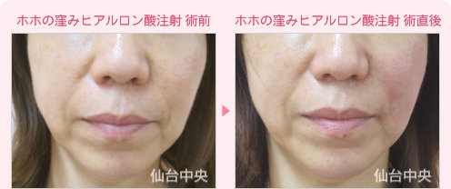 ホホの窪みヒアルロン酸注射 症例写真1