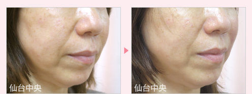 ホホの窪みヒアルロン酸注射 症例写真2