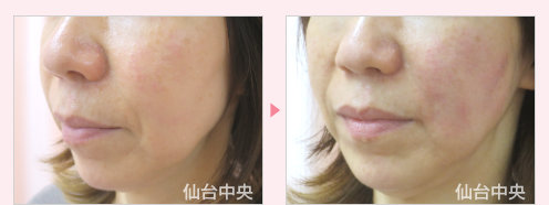 ホホの窪みヒアルロン酸注射 症例写真3