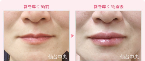 唇を厚く 症例写真1