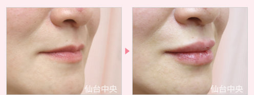唇を厚く 症例写真2