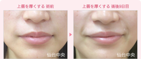 上唇を厚く 症例写真1