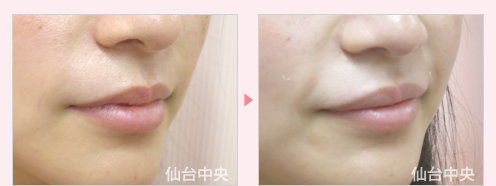 上唇を厚く 症例写真2