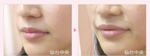 上唇を厚く 症例写真3